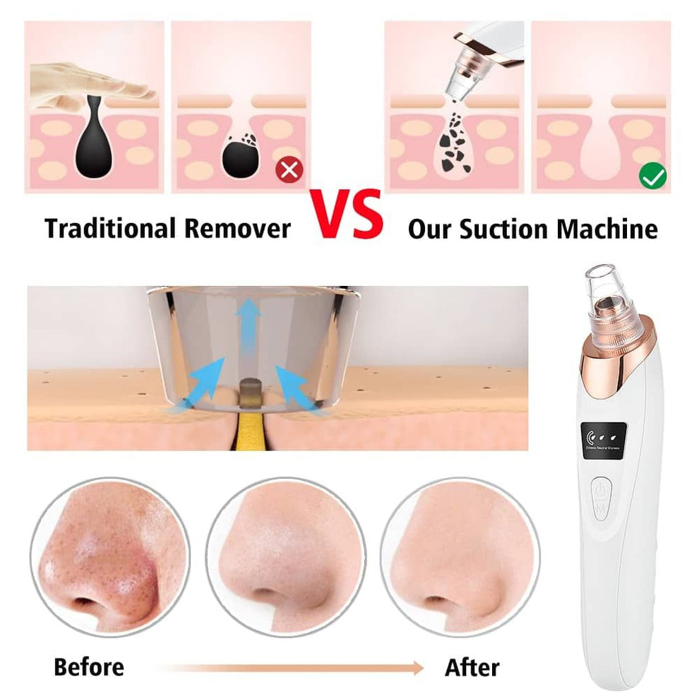 5 in 1  Blackhead Remover