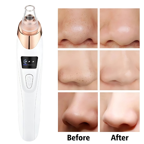 5 in 1  Blackhead Remover